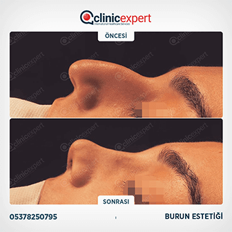 Burun Estetiği
