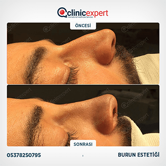 Burun Estetiği