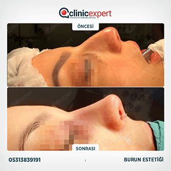 Burun Estetiği