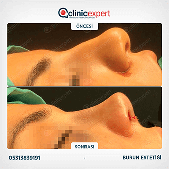 Burun Estetiği