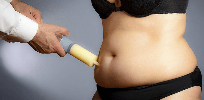 Liposuction Nedir?