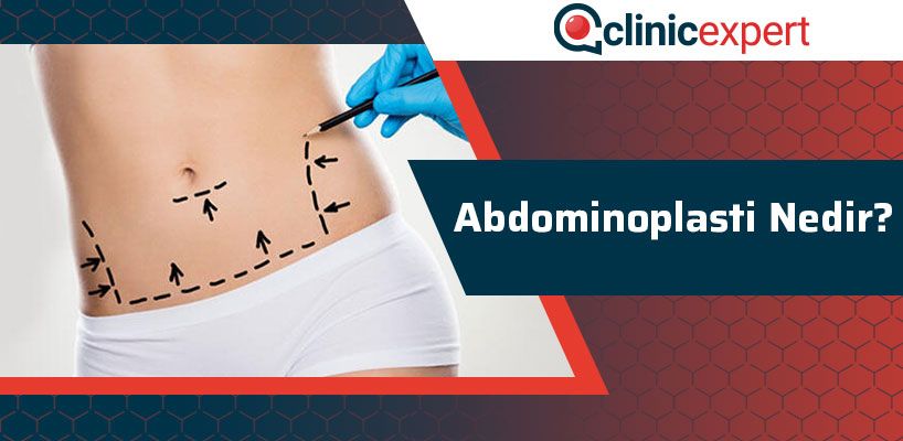 abdominoplasti-nedir-cln