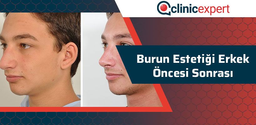 burun-estetigi-erkek-oncesi-sonrasi-cln