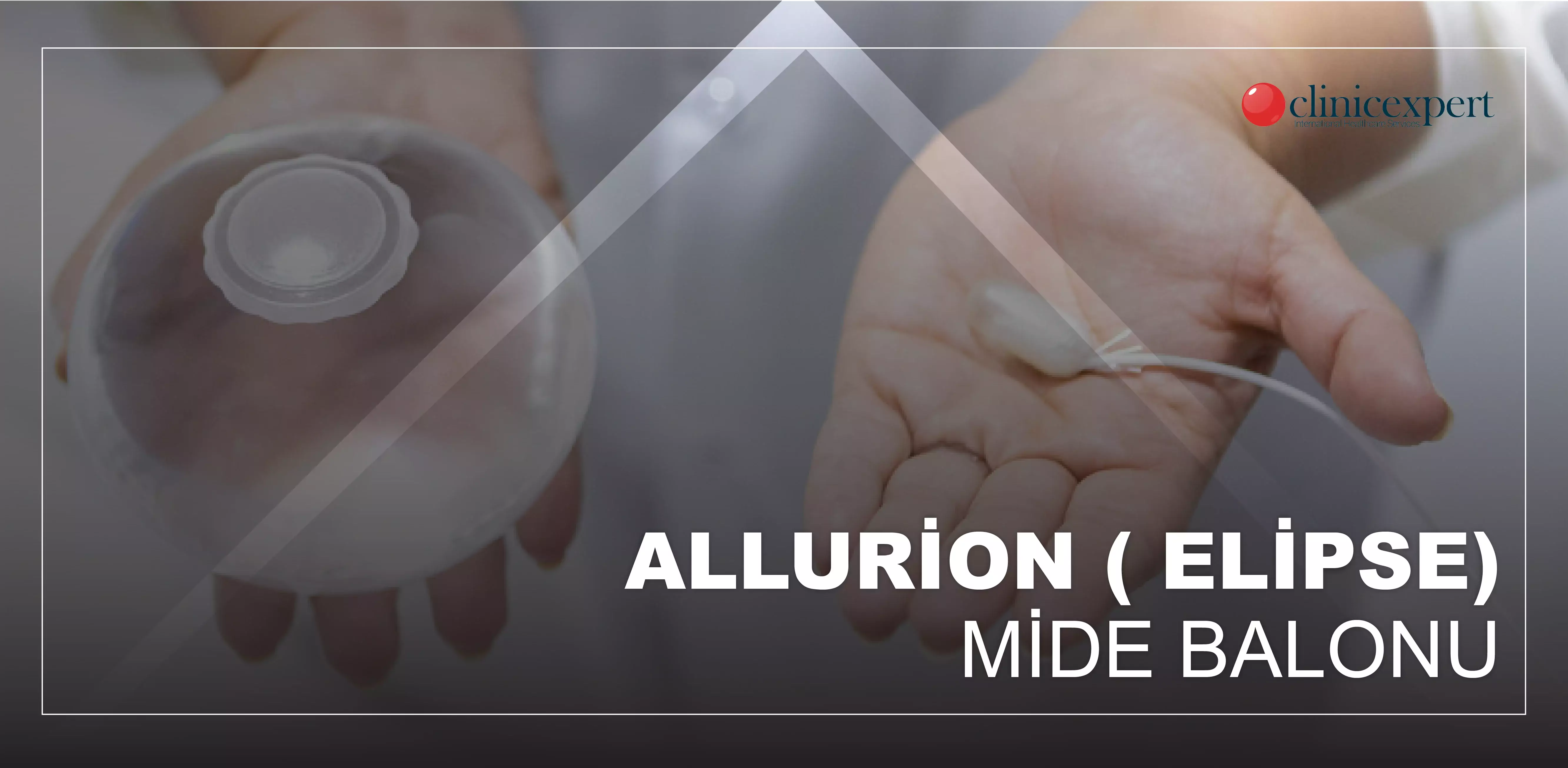 Allurion (Elipse) Mide Balonu