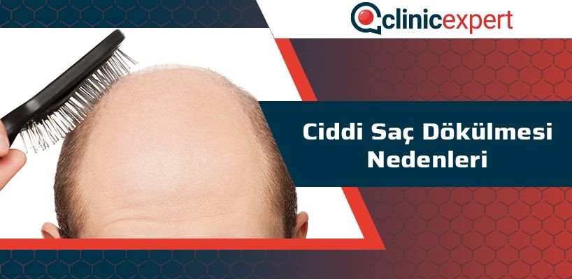 ciddi-sac-dokulmesi-nedenleri-cln-min