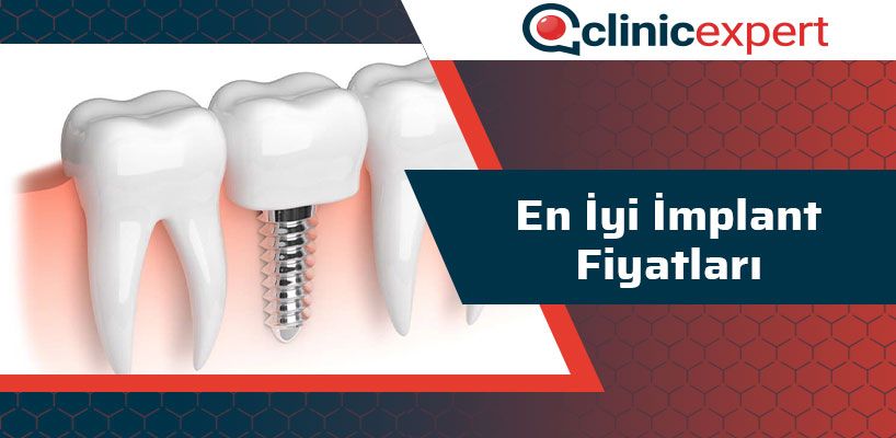 en-iyi-implant-fiyatlari-cln