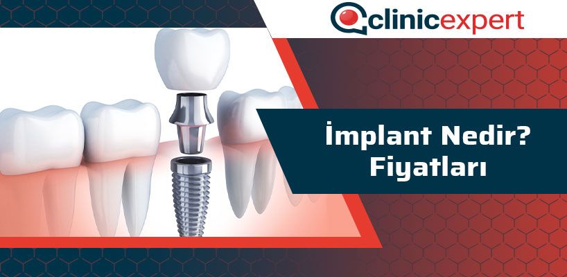 İmplant Nedir Fiyatları