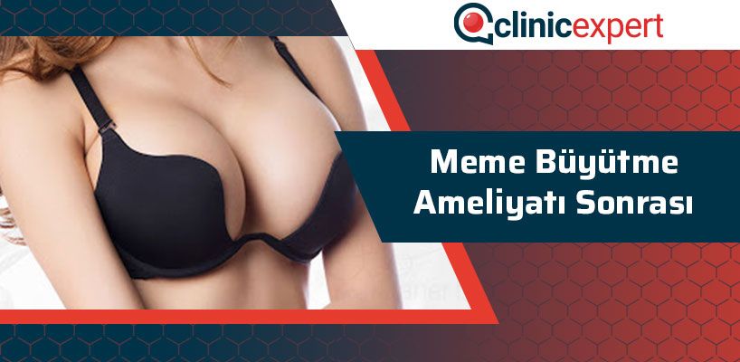 meme-buyutme-ameliyati-sonrasi-cln