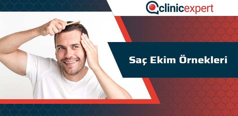 Saç Ekim Örnekleri