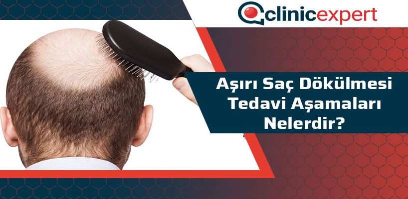 Aşırı Saç Dökülmesi Tedavi Aşamaları Nelerdir?