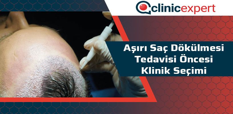 Aşırı Saç Dökülmesi Tedavisi Öncesi Klinik Seçimi