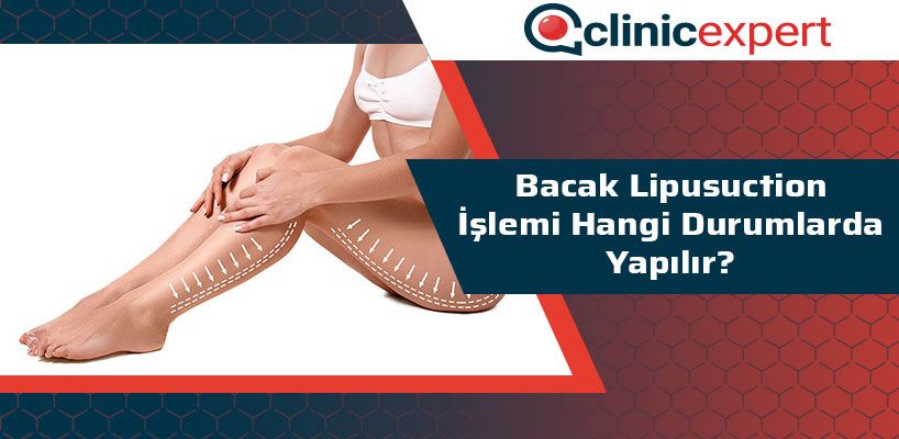 Bacak Lipusuction İşlemi Hangi Durumlarda Yapılır?