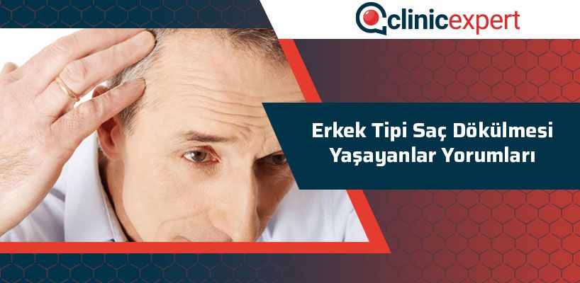 erkek-tipi-sac-dokulmesi-yasayanlar-yorumlari-cln