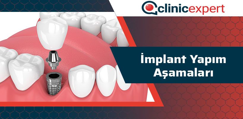 implant-yapim-asamalari-cln