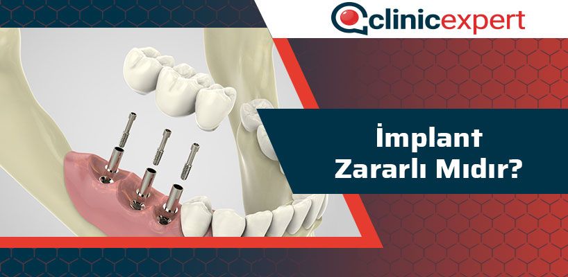 implant-zararli-midir-cln