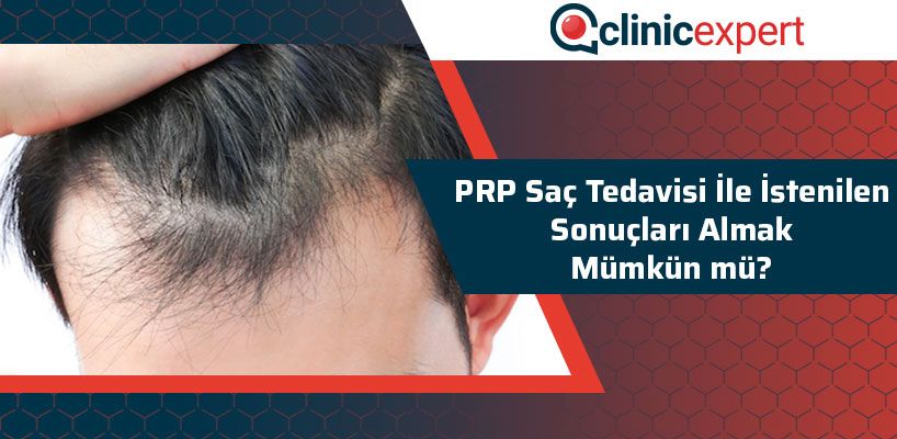 PRP Saç Tedavisi İle İstenilen Sonuçları Almak Mümkün Mü?