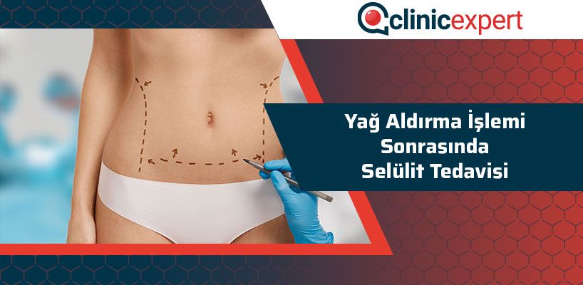 Yağ Aldırma İşlemi Sonrasında Selülit Tedavisi