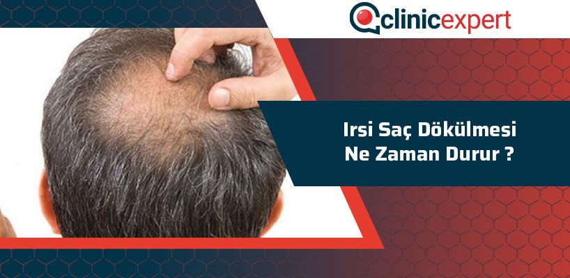 Irsi Saç Dökülmesi Ne Zaman Durur