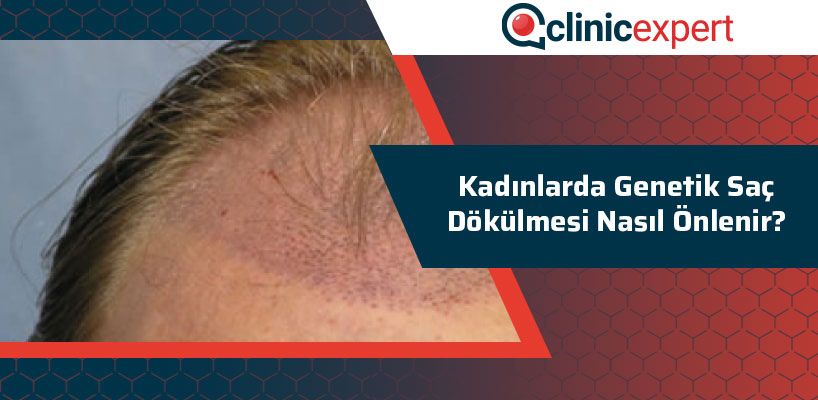 Kadınlarda Genetik Saç Dökülmesi Nasıl Önlenir