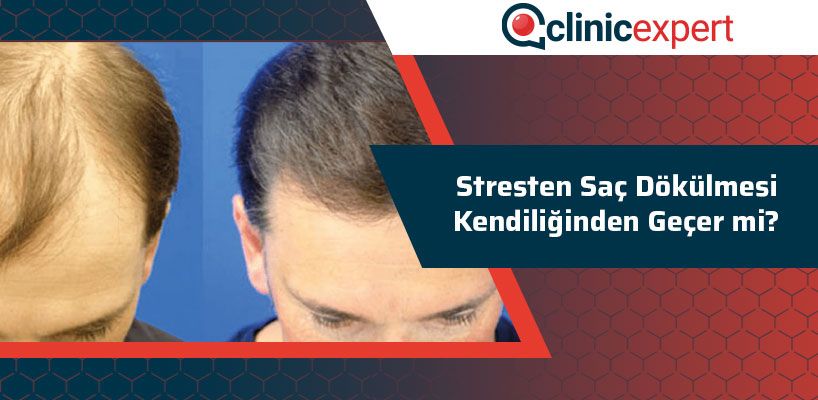 Stresten Saç Dökülmesi Kendiliğinden Geçer Mi  