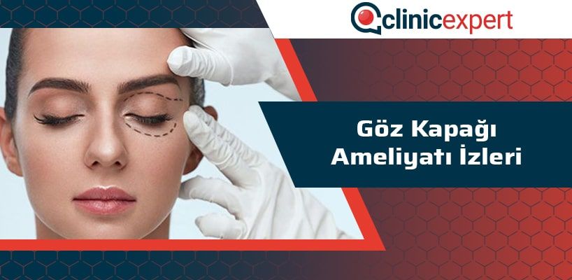 Göz Kapağı Ameliyatı İzleri  