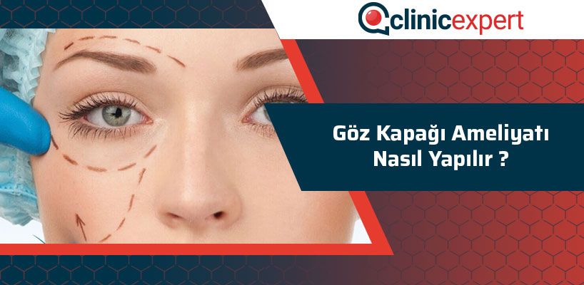 Göz Kapağı Ameliyatı Nasıldır?