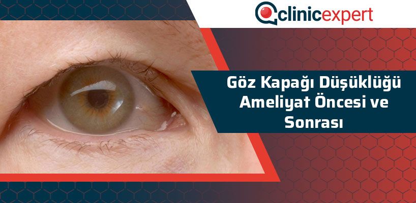 Göz Kapağı Düşüklüğü Ameliyat Öncesi ve Sonrası 