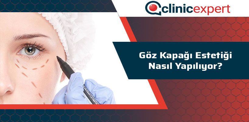 Göz Kapağı Estetiği Nasıl Yapılıyor?