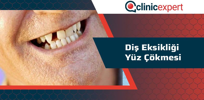 Diş Eksikliği Yüz Çökmesi