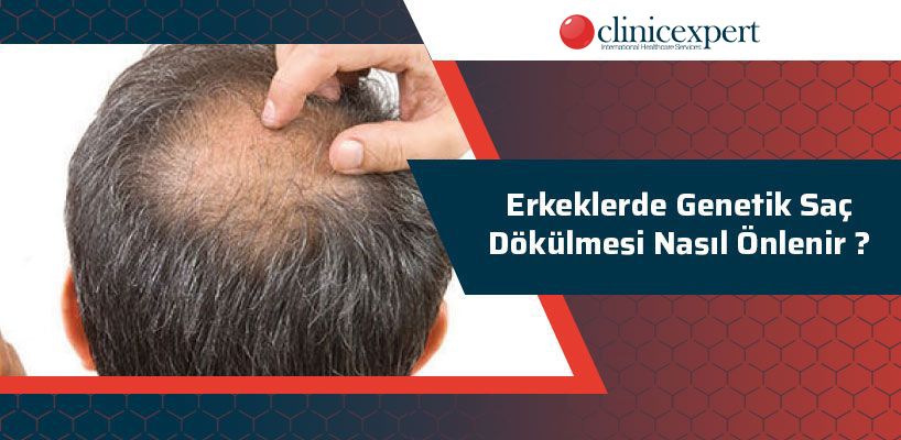 Erkeklerde Genetik Saç Dökümesi Nasıl Önlenir?