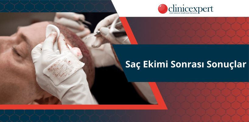 Saç Ekimi Sonrası Sonuçlar